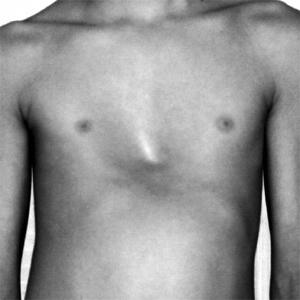 This sunken chest appearance is often recognized at or shortly after birth (congenital) or may be acquired at a later time.