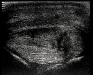 Local analgesia Figure 2a. Transverse ultrasound image of a severe injury to the superficial digital flexor tendon and deep digital flexor tendon of a horse.