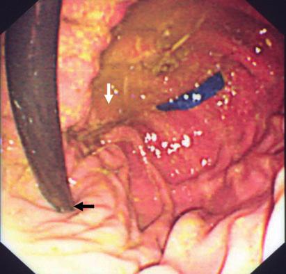 The pylorus is positioned dorsally (arrow), and there is compartmentalisation of the stomach by a soft tissue line (between arrow-heads) of the endoscope or patient, and the gastric landmarks
