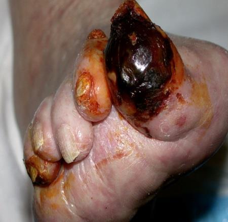 induce infection demarcated areas can allow bacteria in Oedema Management Risk of skin damage