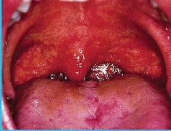 Submandibulárne zväčšenie lymfatických uzlín sa vyskytuje pri bakteriálnej infekcii.
