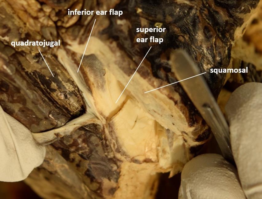 Figure 6. Inferior ear flap with superficial layer separated; superior ear flap is reconstructed.