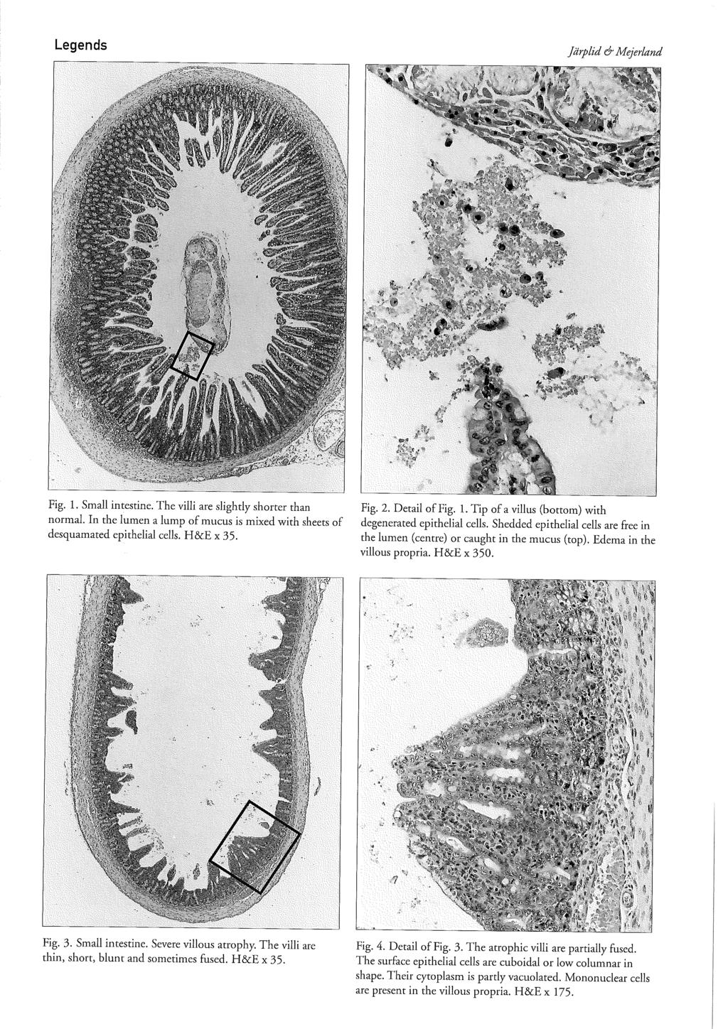 Legends jurplid & Mejerland Fig. 1. Smal1 intestine. The villi are slightly shorter than normal. In the lumen a lump of mucus is mixed with sheets of desquamated epithelial cells. H&E x 35. Fig. 2.