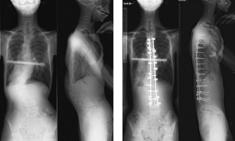 Spine Surg Relat Res 2018; 2(1): 37-41 Figure 3. A 13-year-old male patient with syndromic scoliosis (Marfan syndrome) and pectus excavatum.