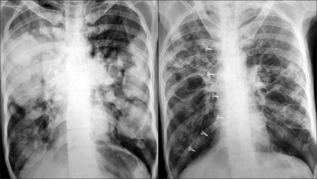 Figure 1: (a)chest X-ray PA view multiple rounded homogenous parenchymal shadows of varying size, 2-5 cm in