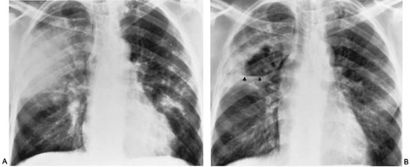 Klebsiella pneumonia. (A) Air-space consolidation involving much of the right upper lobe.