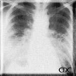 stenosis, pulmonary