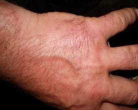 Lesions at a milker, on the hand Figure 1.
