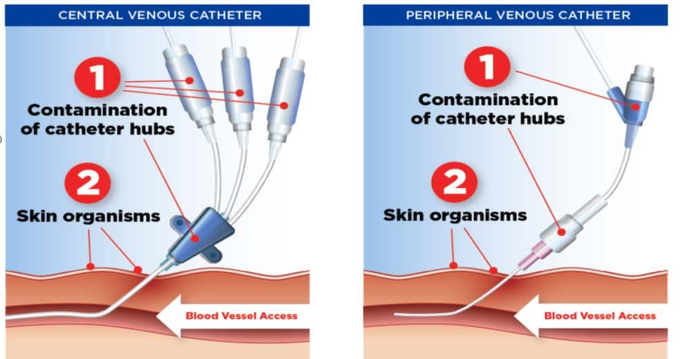 Areas of Opportunity Rebaselining Central Venous Catheters Dialysis