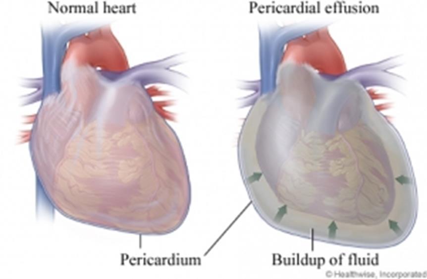 DIAGNOSTIC Pericardial effusion, with cardiac tamponade