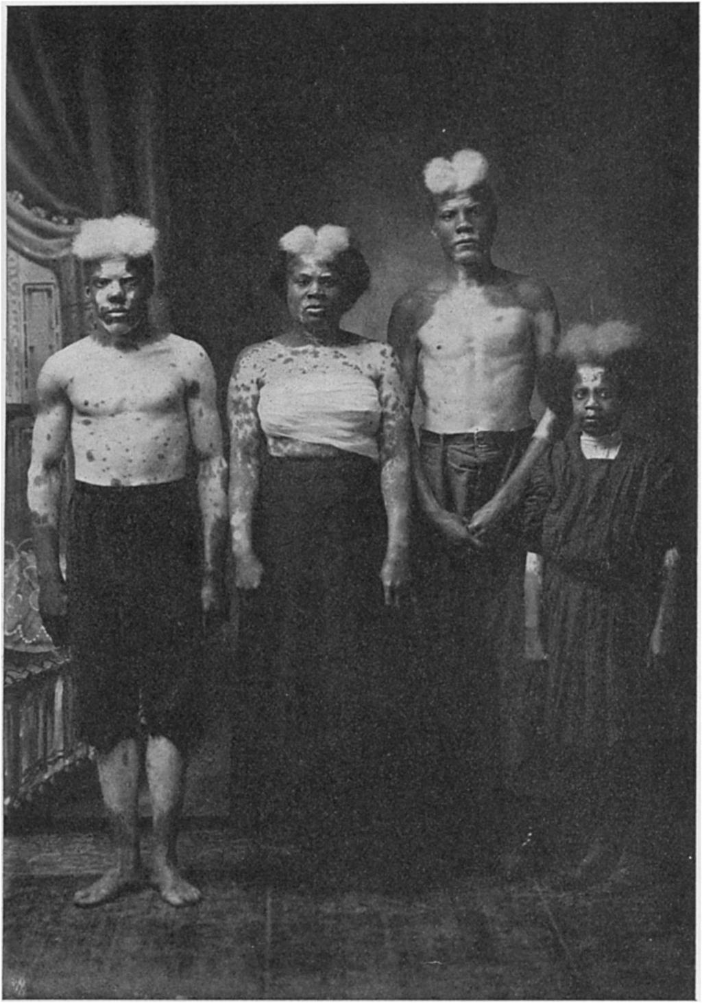No. 553] A FAMILY OF SPOTTED NEGROES 51 L u _A. _, FIG. 1. Mrs. Eliza D., her sons Jim and Robert (the taller one) and daughter, Lillie. Photographed 1910.