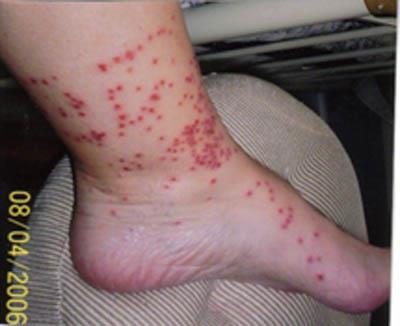 Aggressive biter Lone Star Tick Erlichiosis STARI Tularemia Bite can