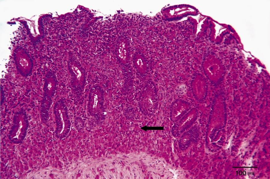 Antibiotic-Responsive Histiocytic Ulcerative Colitis 501 Fig 2. Periodic acid-schiff (PAS) stain of a sample from the colonic biopsy from the same patient as shown in Figure 1.