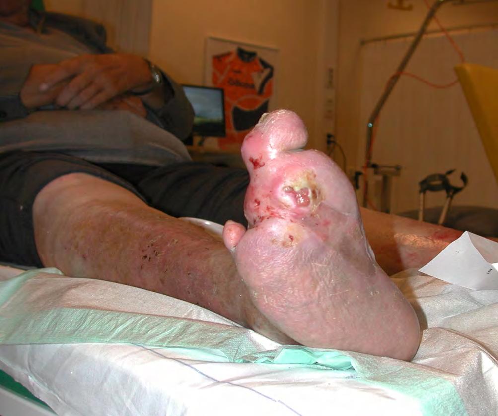 Diabetic foot ulcer infection The major risk factor for severe