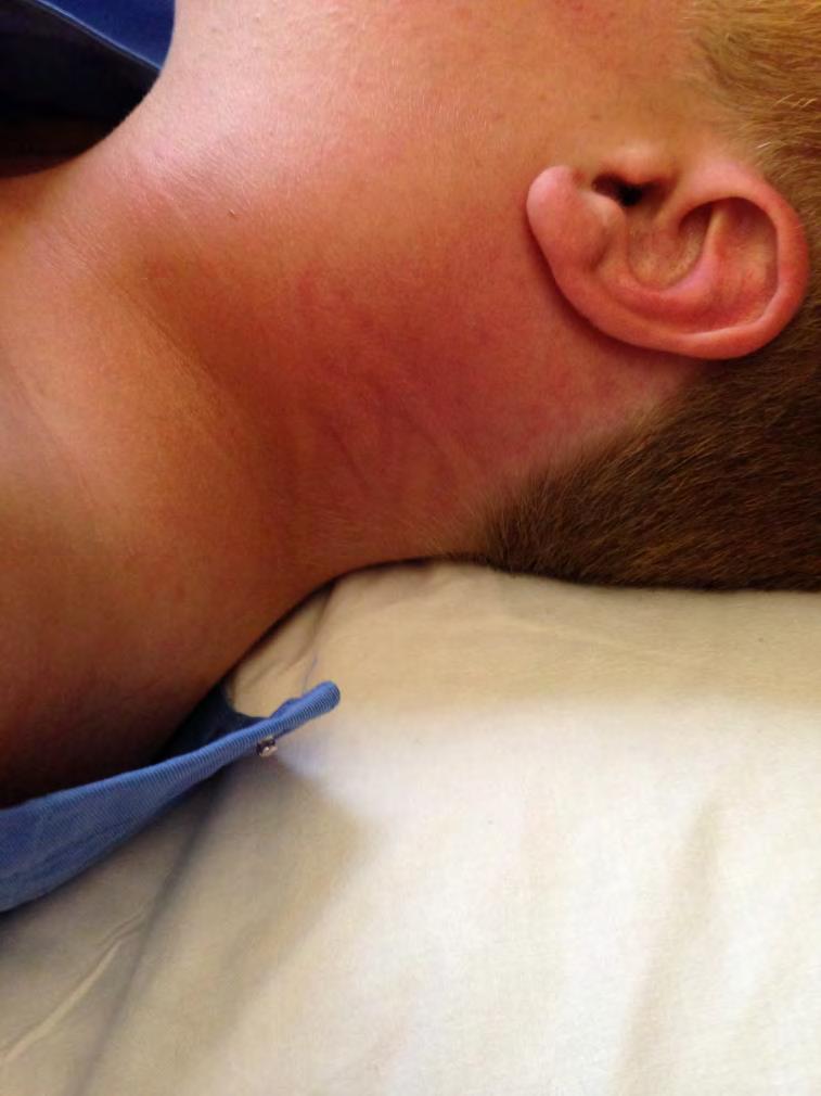 Case 1 A boy with a painful swelling of the neck At drainage, the surgeon only requested aerobic cultures of the pus,