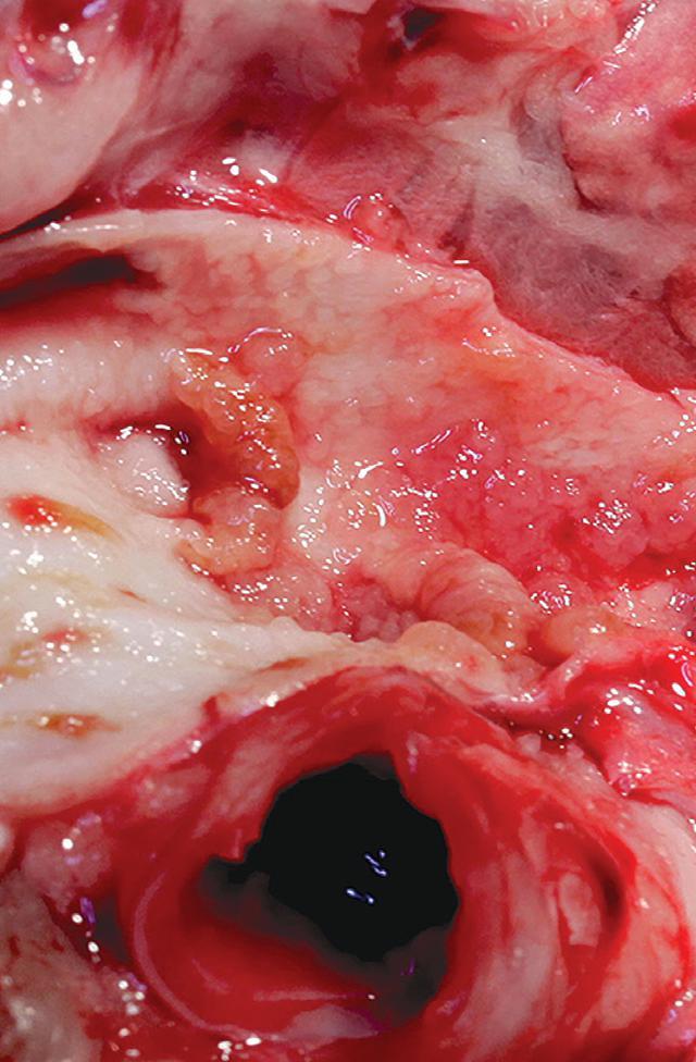 Heartworm disease causes permanent damage to pulmonary arteries.