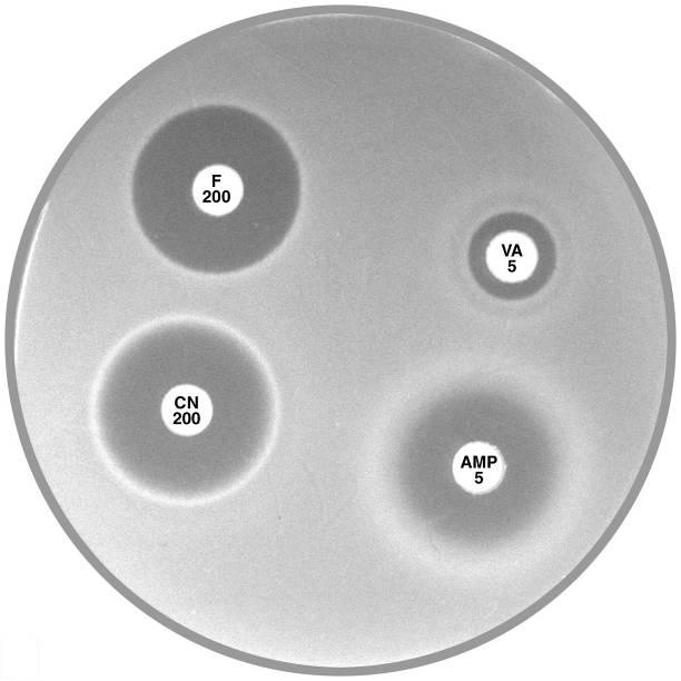the diffuse growth towards the disc is frequently observed with this phenotype. Plate 12.