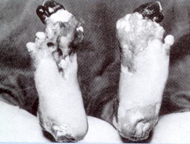 Soldiers tried using whale oil to keep their feet dry,