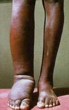 2: THE LEG OF A PATIENT SUFFERING FROM LYMPHATIC FILARIASIS TABLE2: ALL FILARIAL INFECTIONS CAUSE SOME TYPE OF SKIN PROBLEMS IN ADDITION TO SYSTEMIC MANIFESTATIONS DISEASE PARASITE VECTOR
