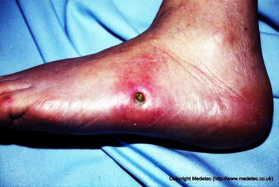 PEDIS grade 2 Local infection only involving skin and