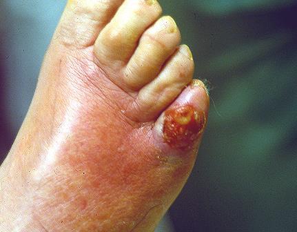 PEDIS grade 3 Local infection with > 2