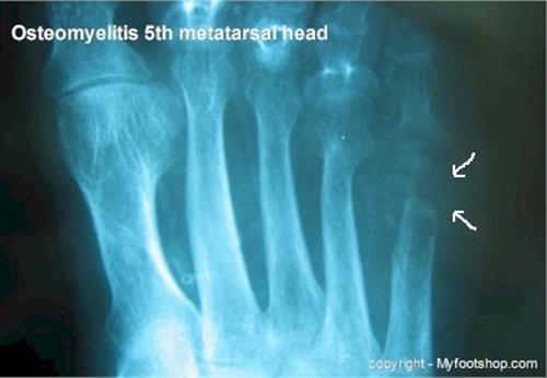 Diagnosing Diabetic Foot Osteomyelitis Probe-to-bone test Plain radiographs Often