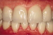can stain developing teeth Widely used in