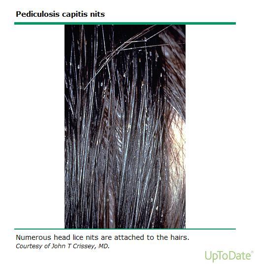 Should find live louse on the head Use louse comb Nits can be confused with
