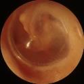 Signs & Symptoms + middle ear effusion with inflammation Irritability, sleep difficulty +/- fever, +/- ear pain, +/- purulent otorrhea (tympanic membrane rupture), +/- URI symptoms Kerschner, JE.