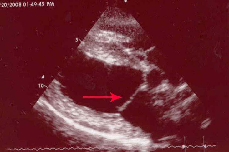 Here is a picture of his Mitral Valve. This is a 7 year old dog who has had 2 previous echoes done. Note the thickening of the valve and the prolapse indicated by the arrow.